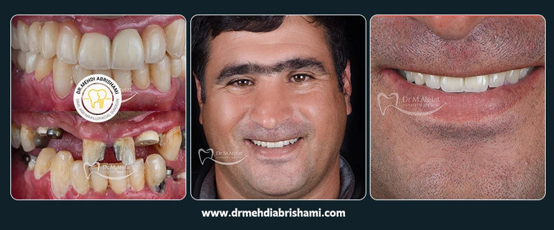 نمونه جراحی و کاشت ایمپلنت در اصفهان در مرکز کاشت ایمپلنت دکتر مهدی ابریشمی