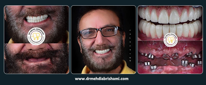 نمونه جراحی و کاشت ایمپلنت در اصفهان در مرکز کاشت ایمپلنت دکتر مهدی ابریشمی