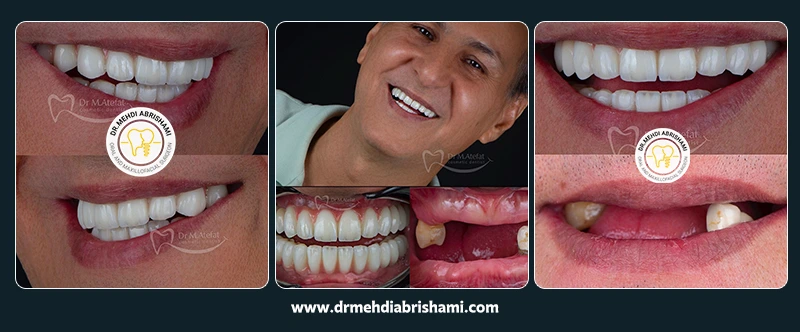نمونه جراحی و کاشت ایمپلنت در اصفهان در مرکز کاشت ایمپلنت دکتر مهدی ابریشمی