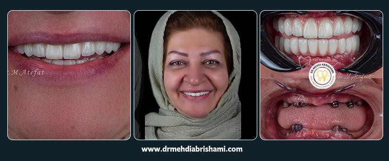 نمونه جراحی و کاشت ایمپلنت در اصفهان در مرکز کاشت ایمپلنت دکتر مهدی ابریشمی