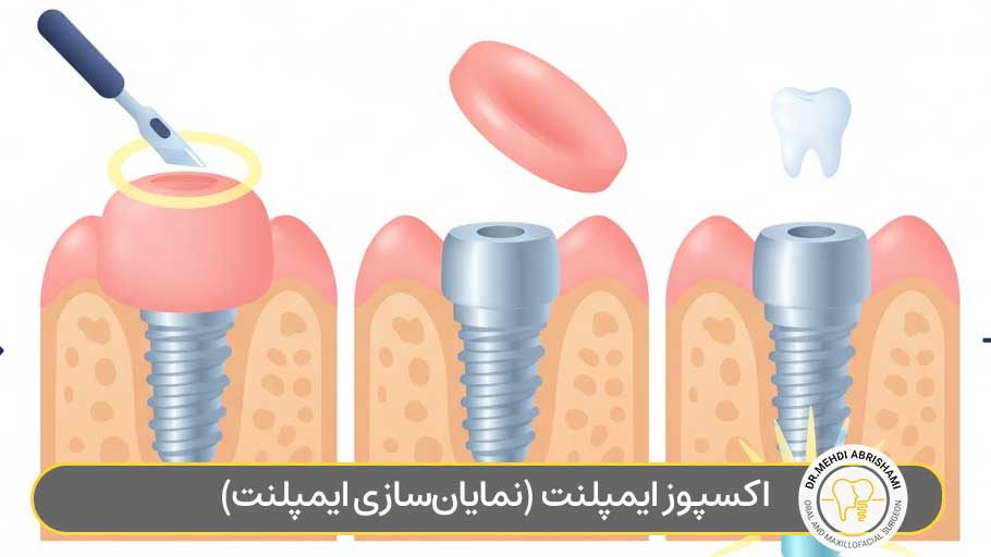 اکسپوز ایمپلنت چیست؟ (نمایان‌سازی ایمپلنت)