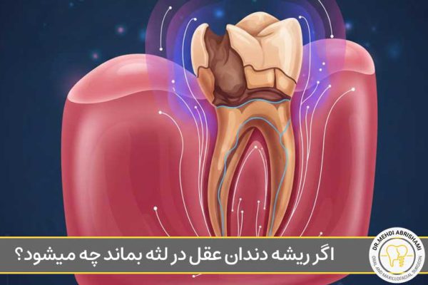 اگر ریشه دندان عقل در لثه بماند چه میشود؟