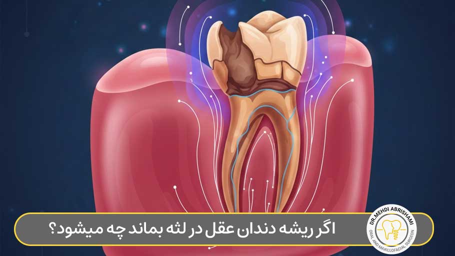 اگر ریشه دندان عقل در لثه بماند چه میشود؟