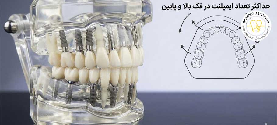 چه تعداد ایمپلنت در هر فک