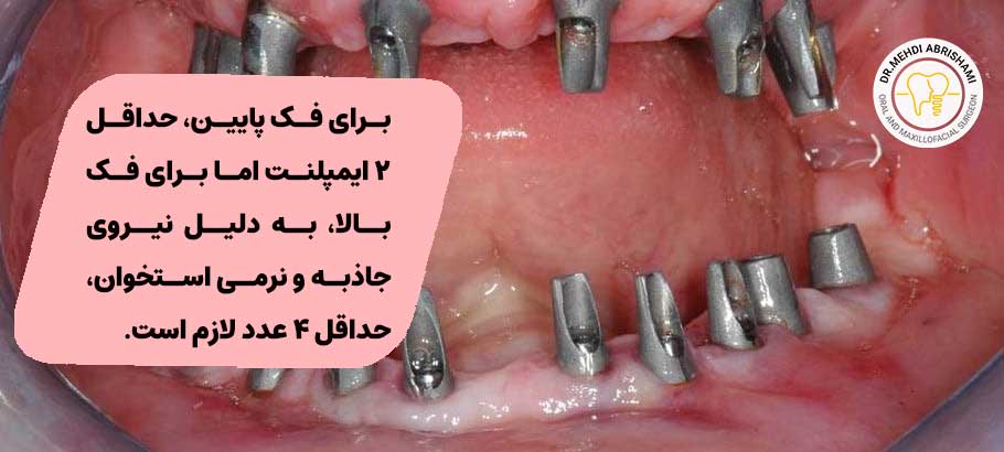 تعداد ایمپلنت برای کل دهان