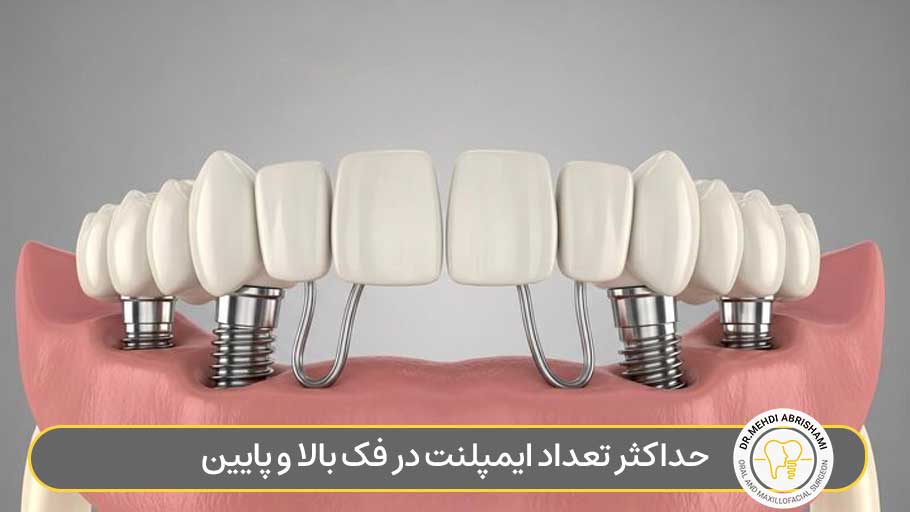 حداکثر تعداد ایمپلنت در فک بالا و پایین