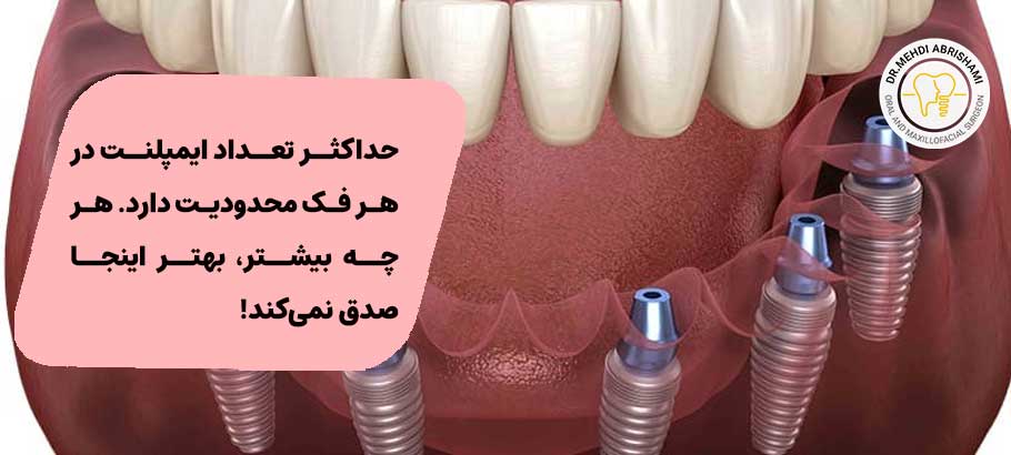 تعداد پایه های ایمپلنت