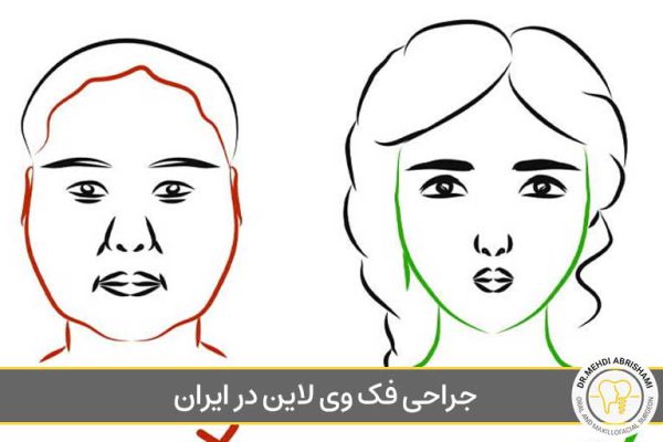 جراحی فک وی لاین در ایران