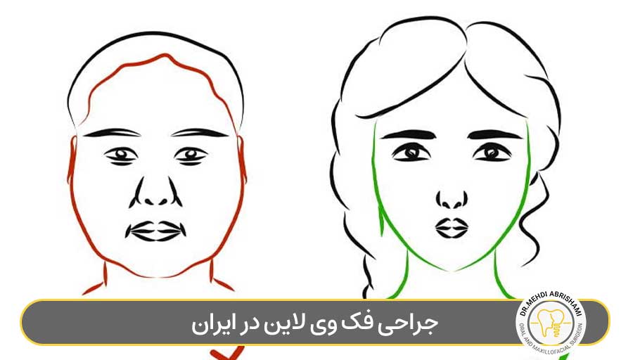 جراحی فک وی لاین در ایران