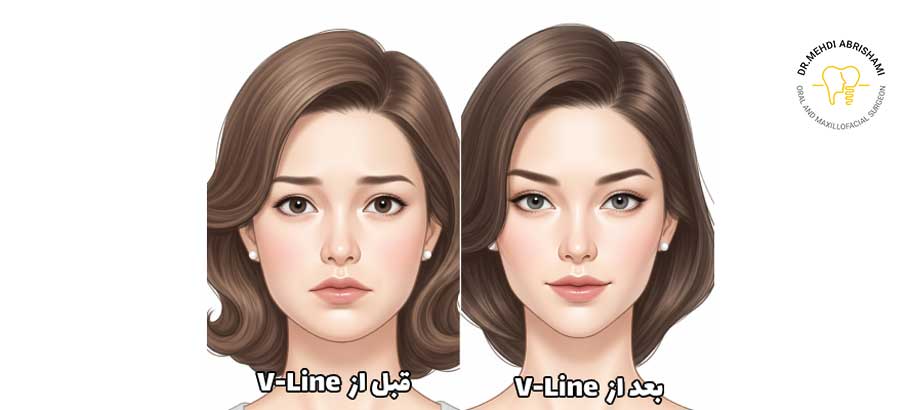 جراحی فک وی لاین چیست؟