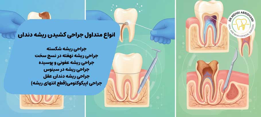 انواع متداول جراحی کشیدن ریشه دندان