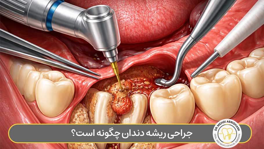 جراحی ریشه دندان چگونه است؟