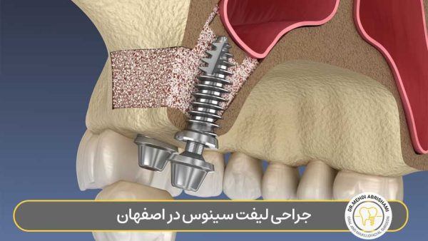 جراحی لیفت سینوس در اصفهان
