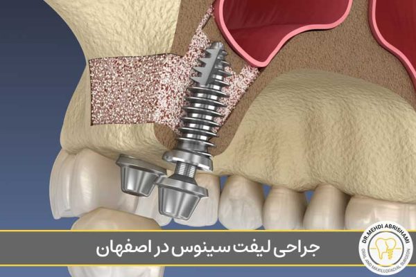 جراحی لیفت سینوس در اصفهان