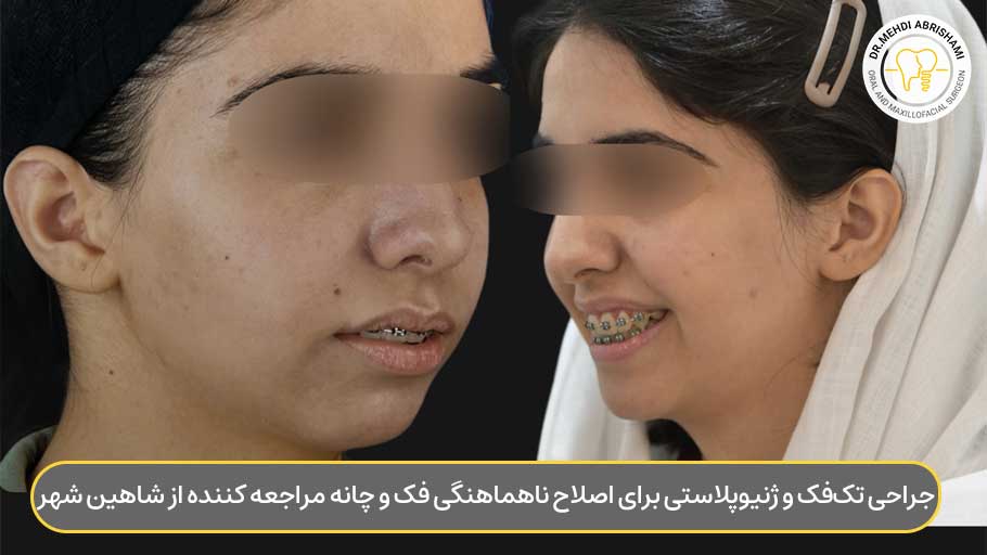 جراحی تک‌فک و ژنیوپلاستی برای اصلاح ناهماهنگی فک و چانه مراجعه کننده از شاهین شهر