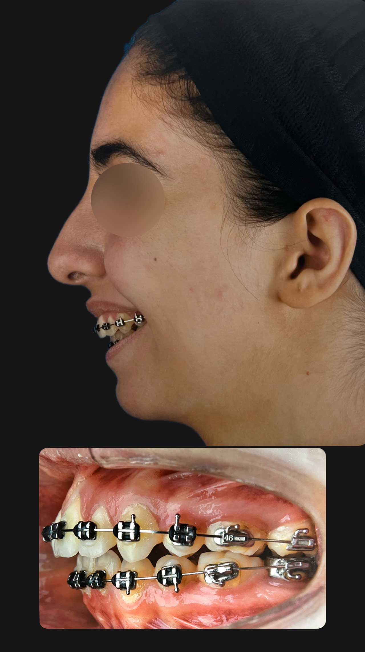 جراحی تک‌فک و ژنیوپلاستی برای اصلاح ناهماهنگی فک و چانه مراجعه کننده از شاهین شهر