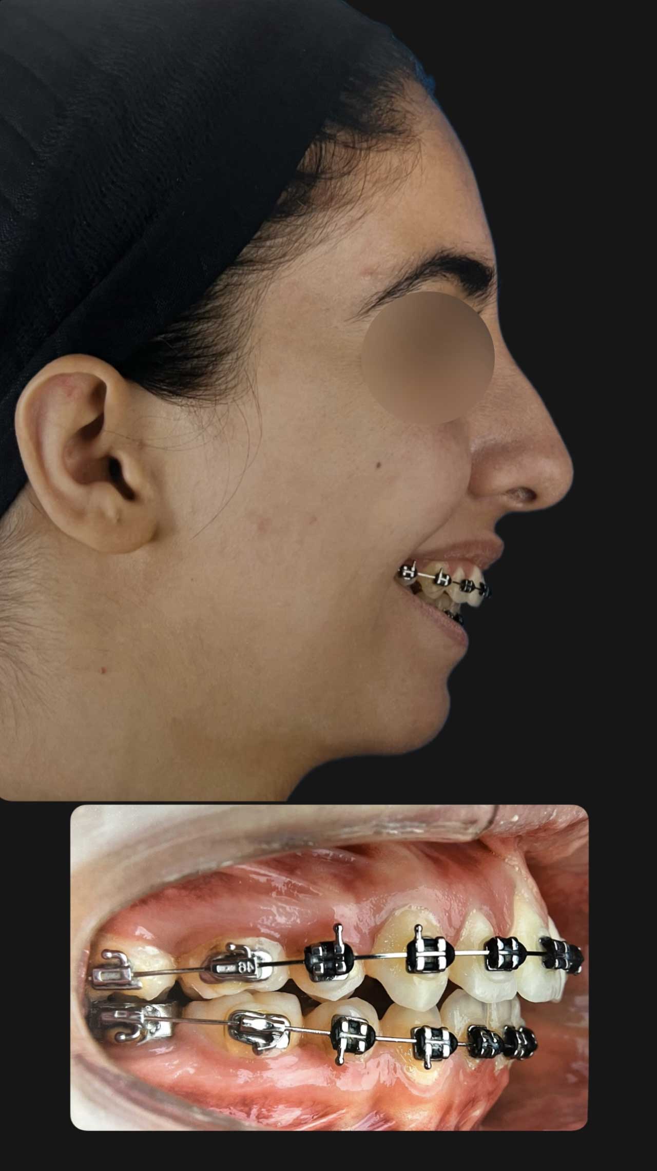 جراحی تک‌فک و ژنیوپلاستی برای اصلاح ناهماهنگی فک و چانه مراجعه کننده از شاهین شهر