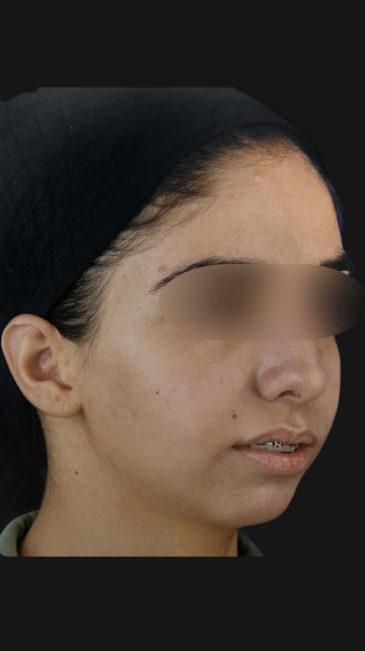 جراحی تک‌فک و ژنیوپلاستی برای اصلاح ناهماهنگی فک و چانه مراجعه کننده از شاهین شهر توسط دکتر مهدی ابریشمی