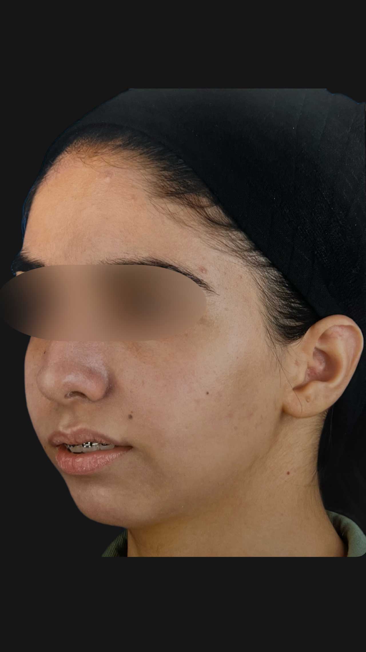 جراحی تک‌فک و ژنیوپلاستی برای اصلاح ناهماهنگی فک و چانه مراجعه کننده از شاهین شهر توسط دکتر مهدی ابریشمی