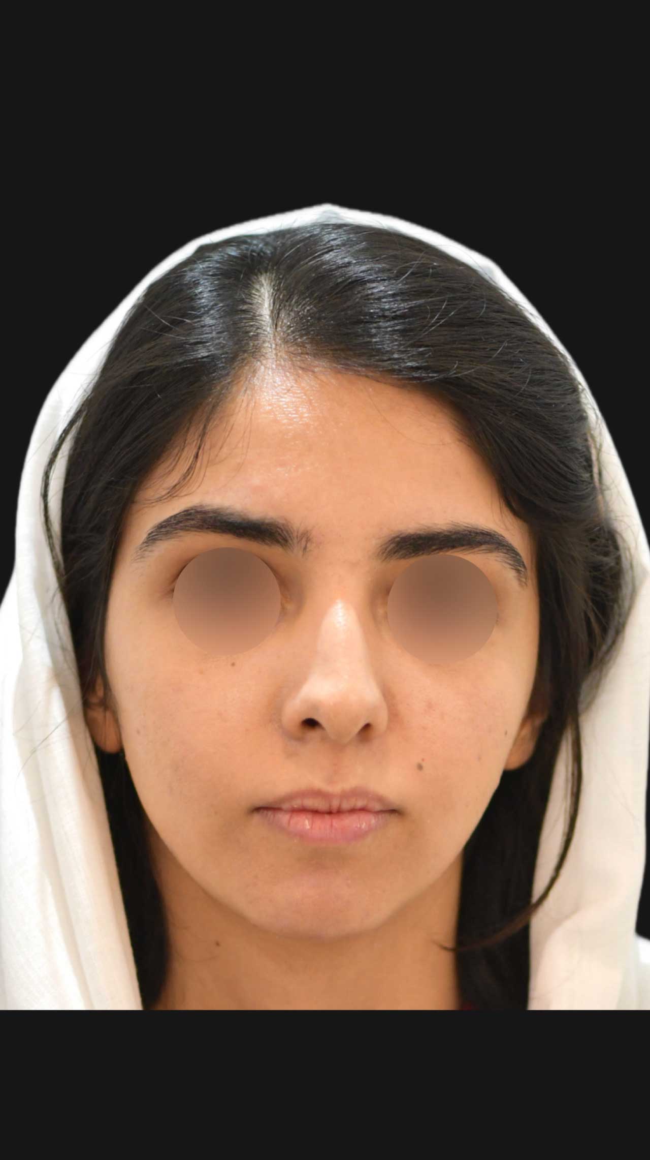 جراحی تک‌فک و ژنیوپلاستی برای اصلاح ناهماهنگی فک و چانه مراجعه کننده از شاهین شهر توسط دکتر مهدی ابریشمی