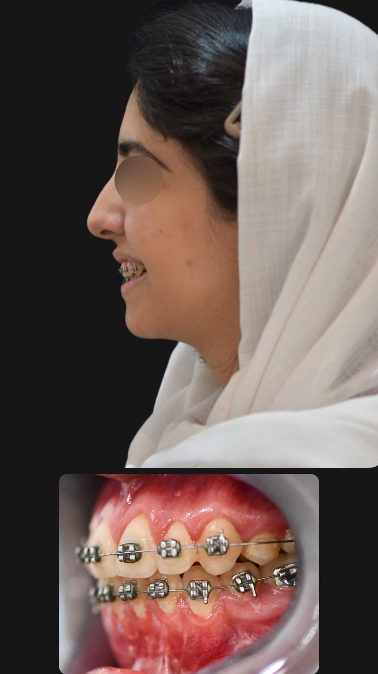 جراحی تک‌فک و ژنیوپلاستی برای اصلاح ناهماهنگی فک و چانه مراجعه کننده از شاهین شهر