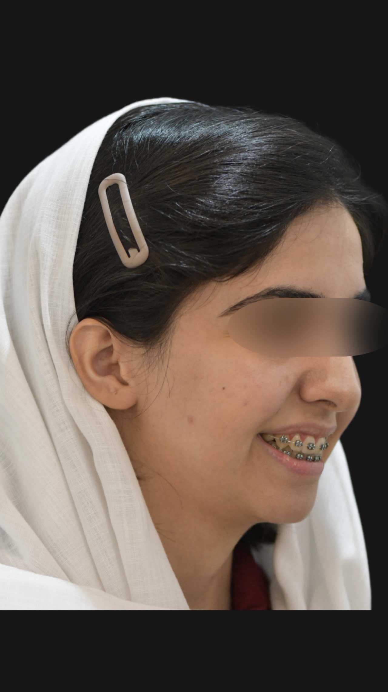 جراحی تک‌فک و ژنیوپلاستی برای اصلاح ناهماهنگی فک و چانه مراجعه کننده از شاهین شهر