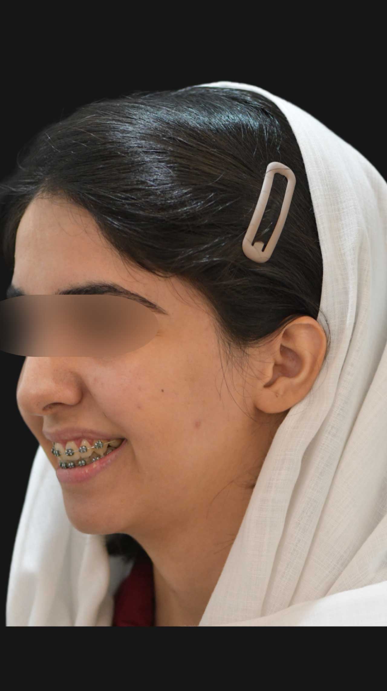 جراحی تک‌فک و ژنیوپلاستی برای اصلاح ناهماهنگی فک و چانه مراجعه کننده از شاهین شهر